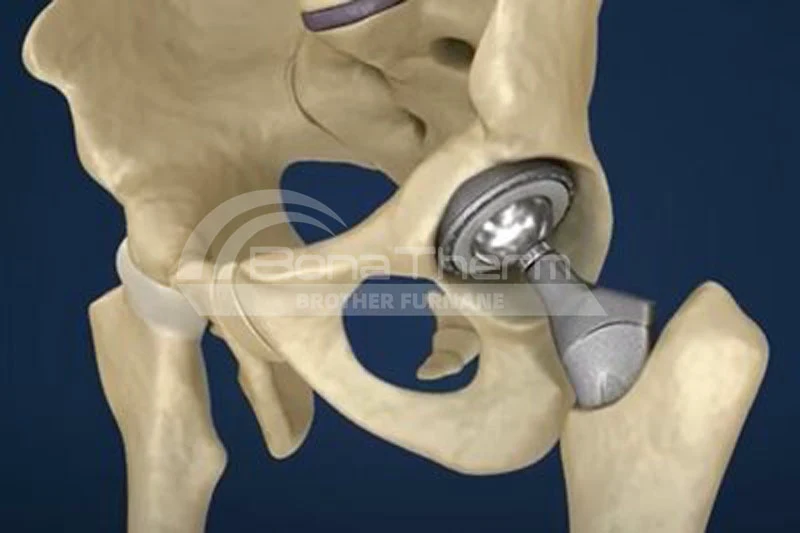 orthopedic-implant